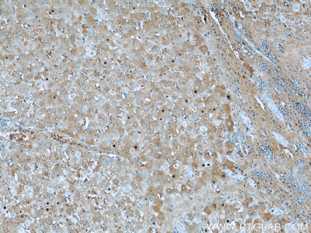 Immunohistochemistry (IHC) staining of human liver cancer tissue using Albumin Polyclonal antibody (16475-1-AP)