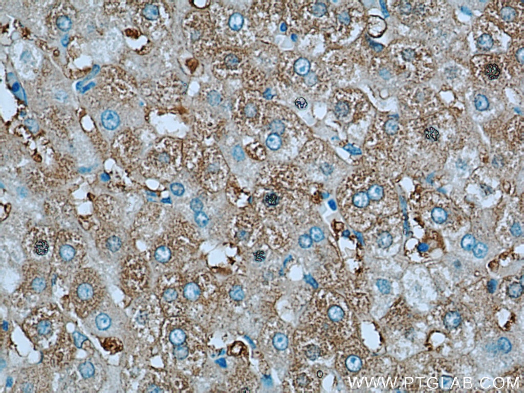 IHC staining of human liver cancer using 16475-1-AP