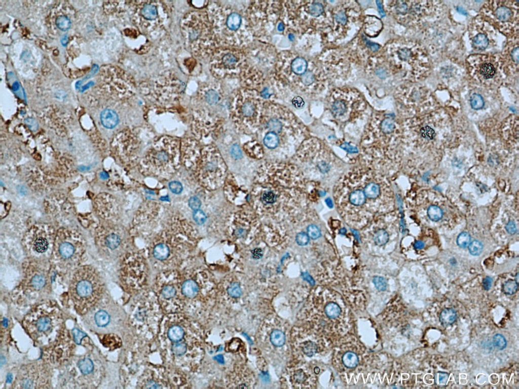 Immunohistochemistry (IHC) staining of human liver cancer tissue using Albumin Polyclonal antibody (16475-1-AP)