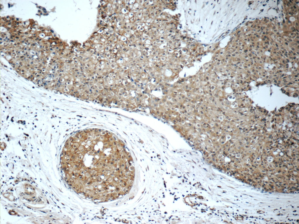 Immunohistochemistry (IHC) staining of human breast cancer tissue using ALCAM Polyclonal antibody (21972-1-AP)