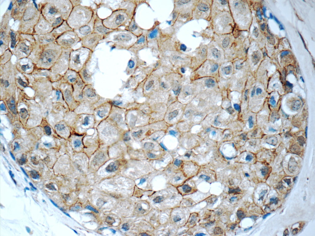 Immunohistochemistry (IHC) staining of human breast cancer tissue using ALCAM Polyclonal antibody (21972-1-AP)