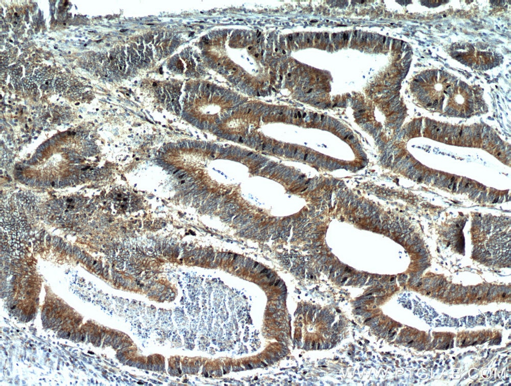 Immunohistochemistry (IHC) staining of human colon cancer tissue using ALCAM Polyclonal antibody (21972-1-AP)