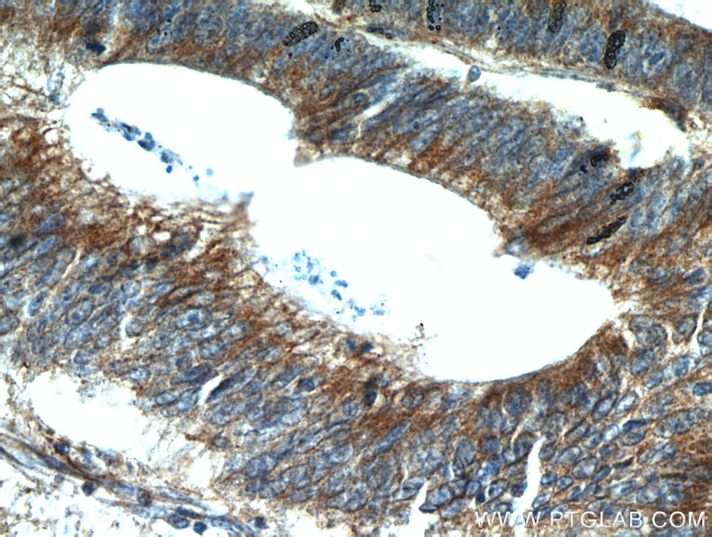 Immunohistochemistry (IHC) staining of human colon cancer tissue using ALCAM Polyclonal antibody (21972-1-AP)