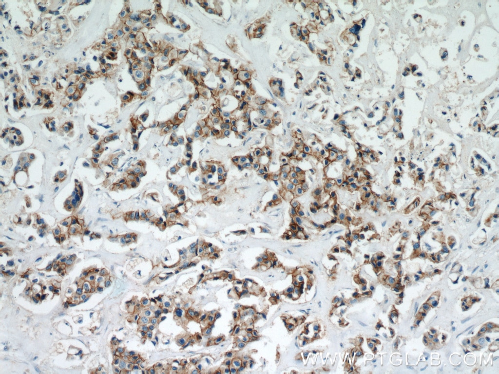 Immunohistochemistry (IHC) staining of human breast cancer tissue using ALCAM Polyclonal antibody (21972-1-AP)