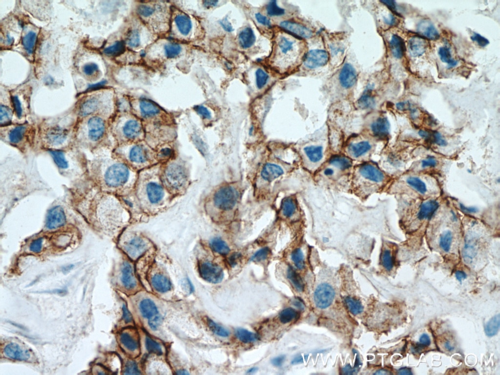 Immunohistochemistry (IHC) staining of human breast cancer tissue using ALCAM Polyclonal antibody (21972-1-AP)