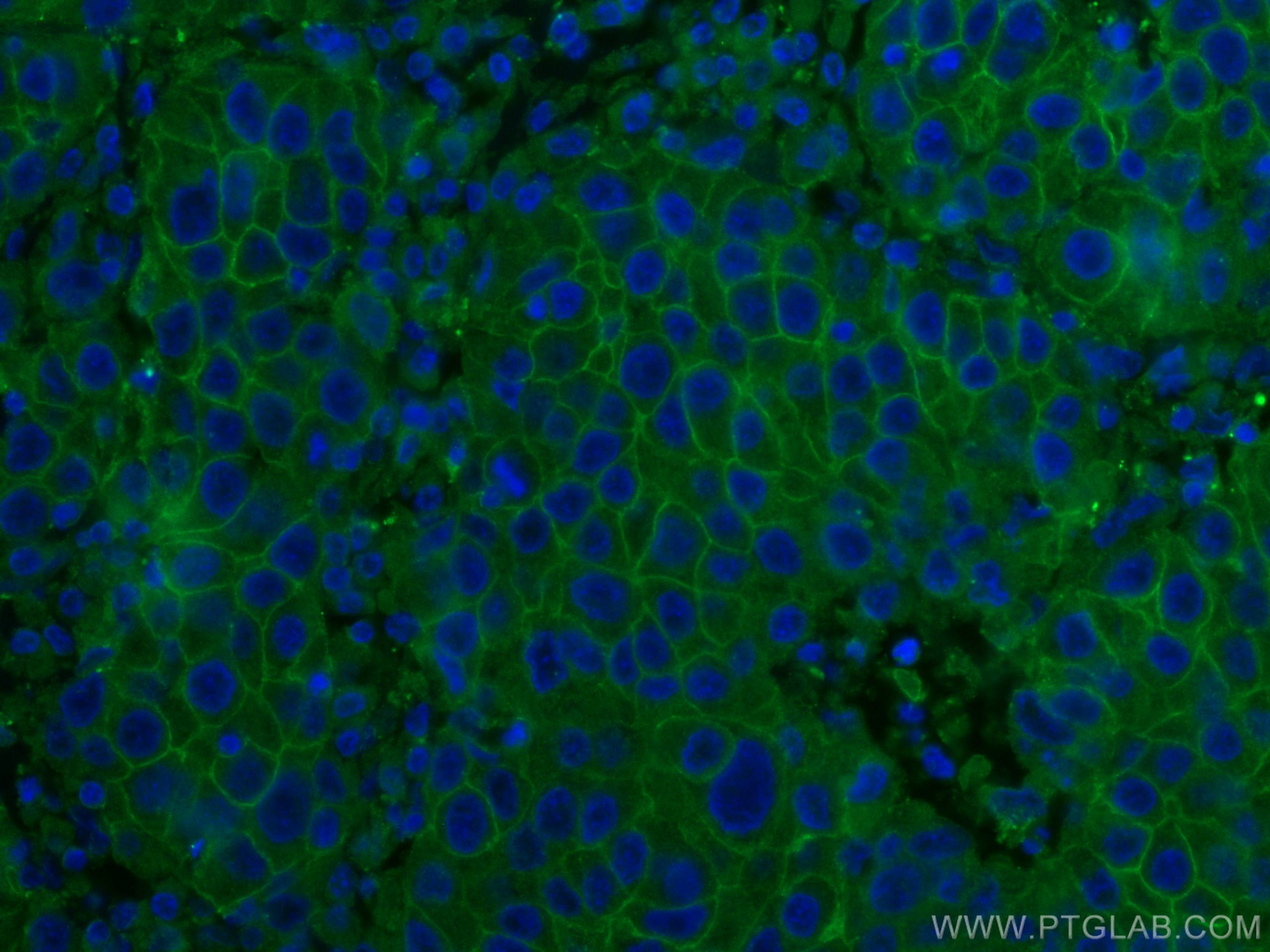 Immunofluorescence (IF) / fluorescent staining of human breast cancer tissue using ALCAM Monoclonal antibody (67768-1-Ig)