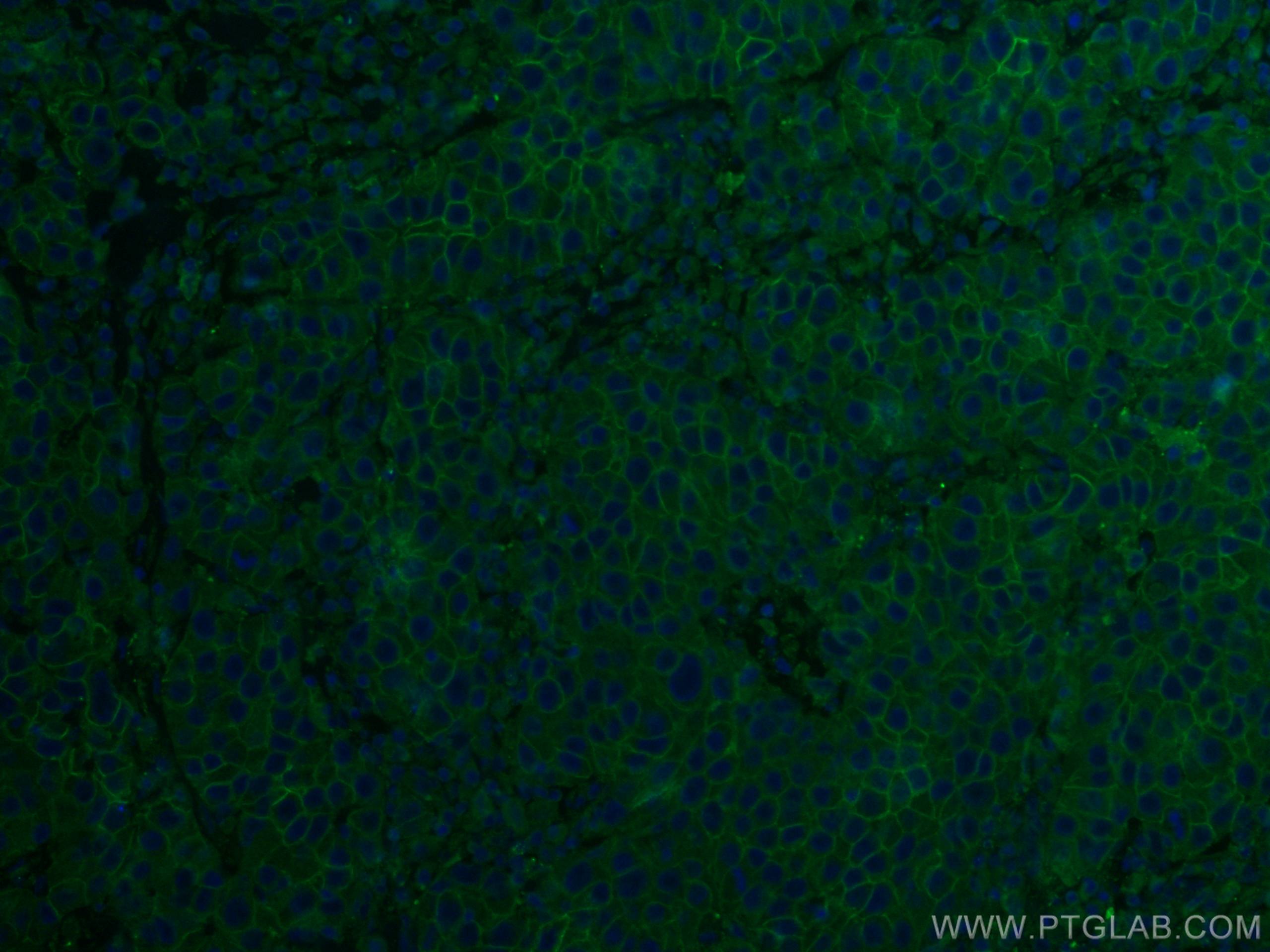 Immunofluorescence (IF) / fluorescent staining of human breast cancer tissue using ALCAM Monoclonal antibody (67768-1-Ig)