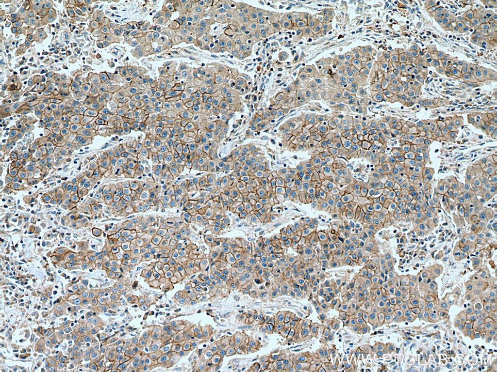 Immunohistochemistry (IHC) staining of human breast cancer tissue using ALCAM Monoclonal antibody (67768-1-Ig)