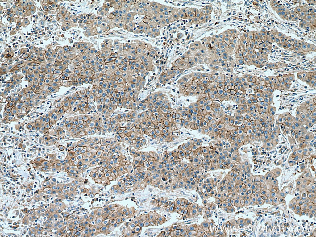 IHC staining of human breast cancer using 67768-1-Ig