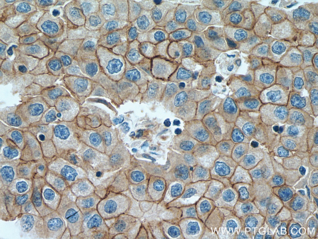 IHC staining of human breast cancer using 67768-1-Ig