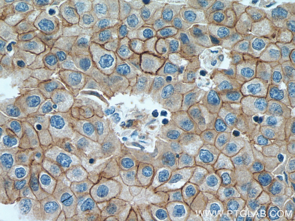 Immunohistochemistry (IHC) staining of human breast cancer tissue using ALCAM Monoclonal antibody (67768-1-Ig)