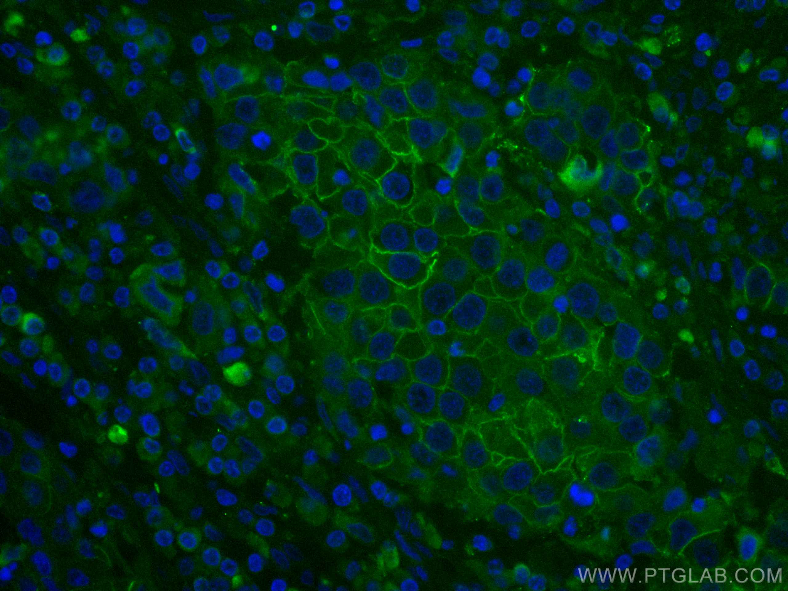 Immunofluorescence (IF) / fluorescent staining of human breast cancer tissue using CoraLite® Plus 488-conjugated ALCAM Monoclonal ant (CL488-67768)