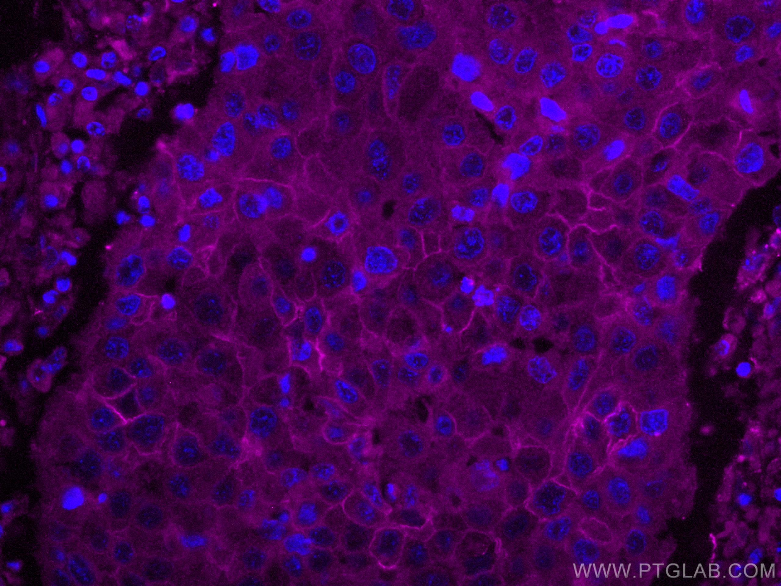 IF Staining of human breast cancer using CL647-67768