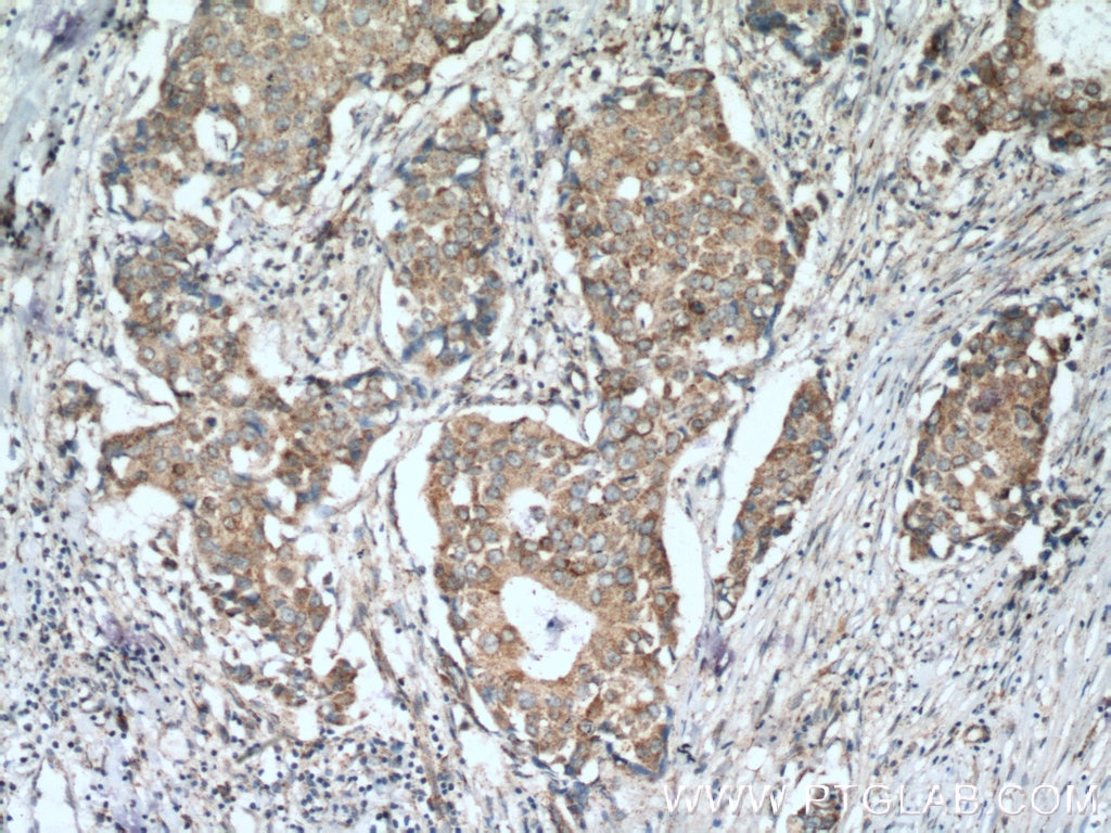 Immunohistochemistry (IHC) staining of human breast cancer tissue using P5CS Polyclonal antibody (17719-1-AP)