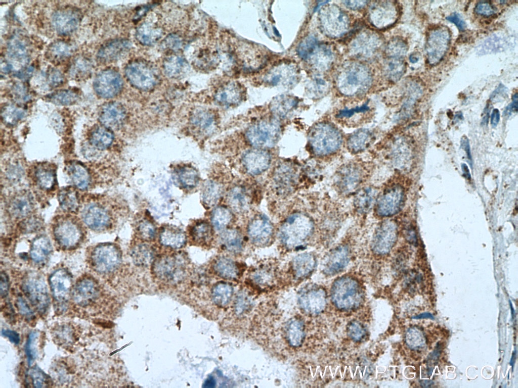 Immunohistochemistry (IHC) staining of human breast cancer tissue using P5CS Polyclonal antibody (17719-1-AP)