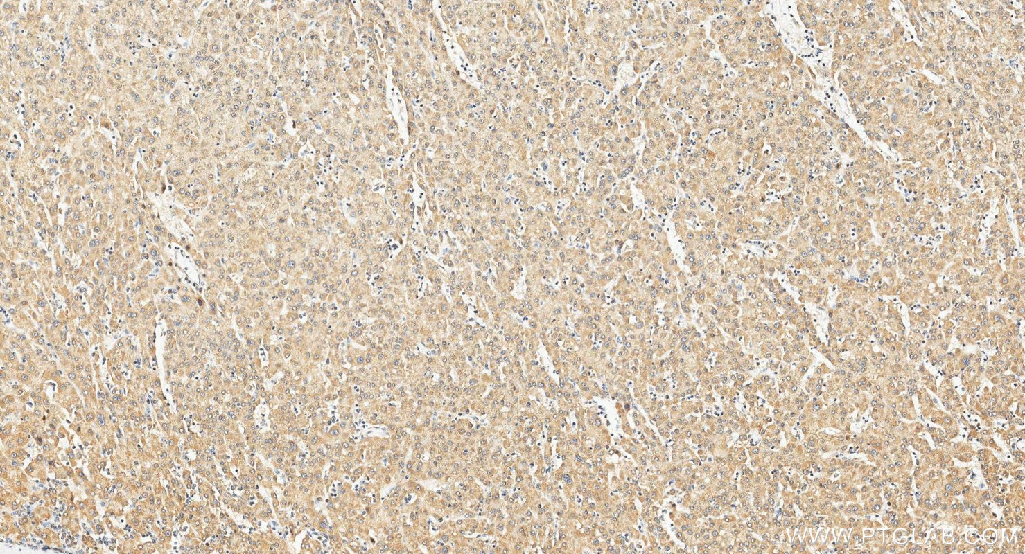 Immunohistochemistry (IHC) staining of human liver cancer tissue using P5CS Polyclonal antibody (17719-1-AP)
