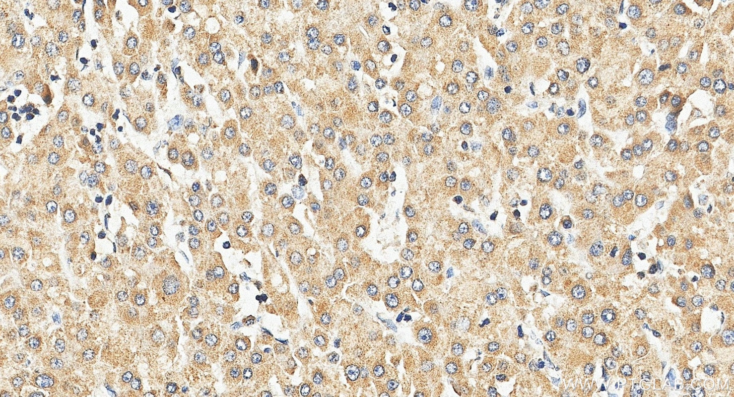 Immunohistochemistry (IHC) staining of human liver cancer tissue using P5CS Polyclonal antibody (17719-1-AP)