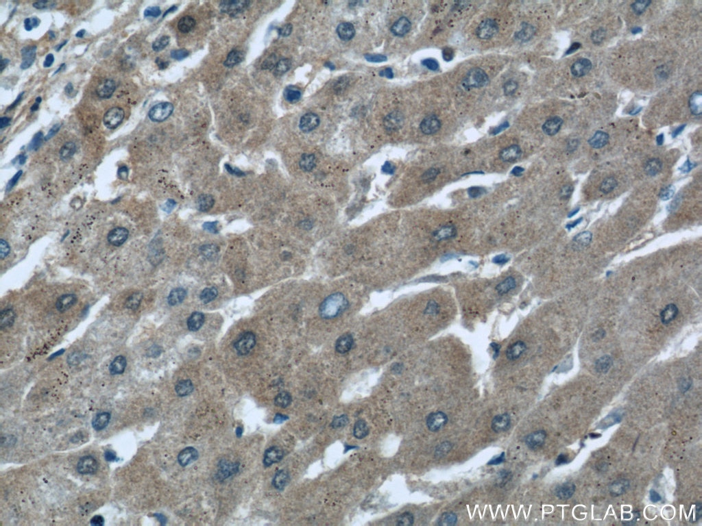 Immunohistochemistry (IHC) staining of human hepatocirrhosis tissue using ALDH1A1-specific Polyclonal antibody (22109-1-AP)