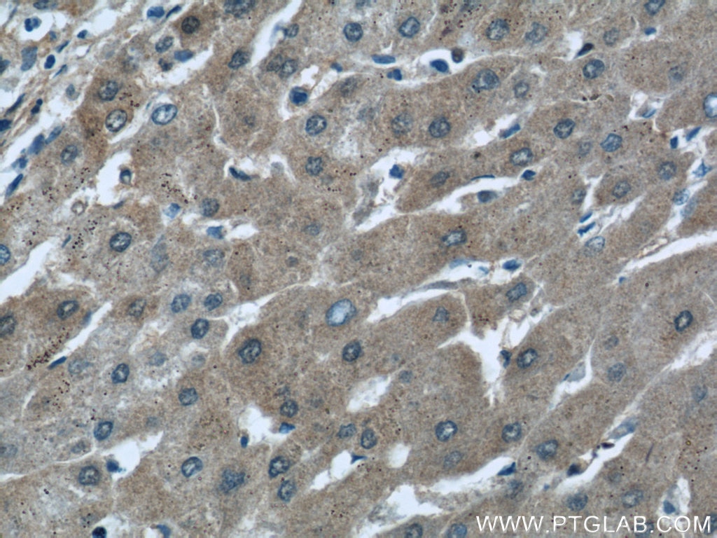 Immunohistochemistry (IHC) staining of human hepatocirrhosis tissue using ALDH1A1-specific Polyclonal antibody (22109-1-AP)