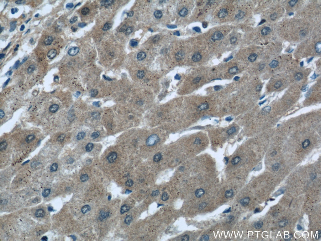 IHC staining of human hepatocirrhosis using 22109-1-AP