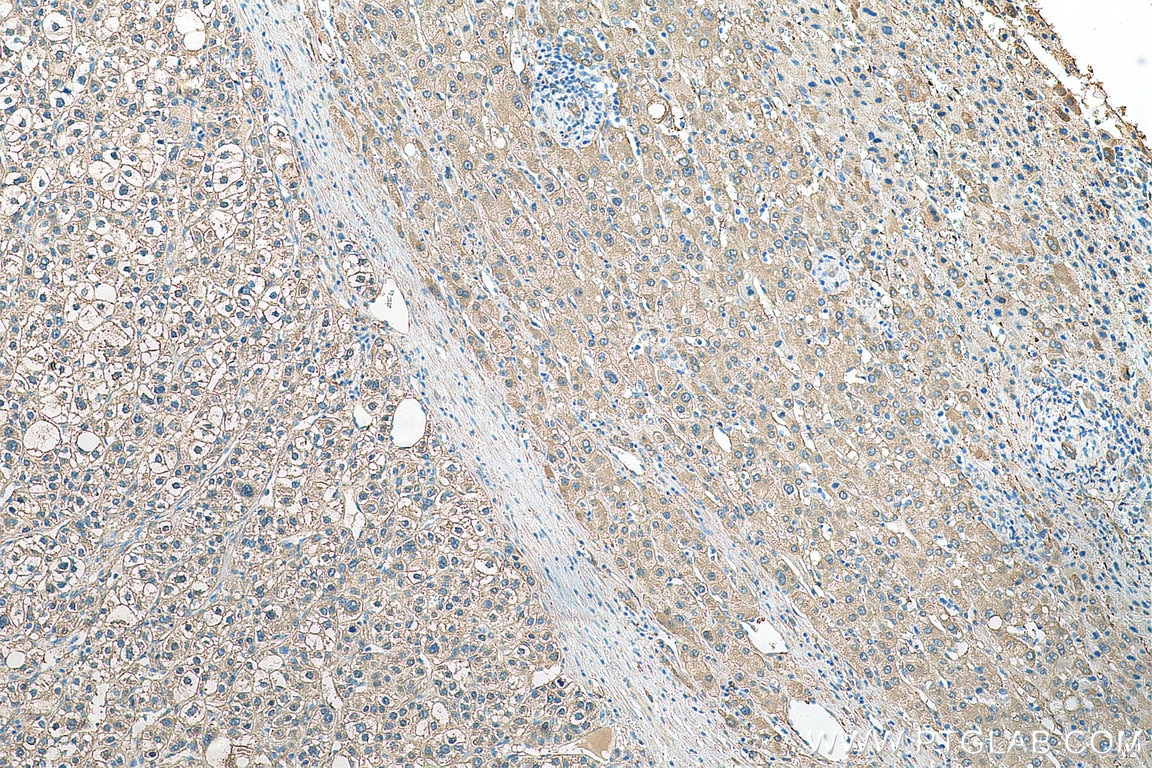 Immunohistochemistry (IHC) staining of human liver cancer tissue using ALDH1A3 Polyclonal antibody (29373-1-AP)