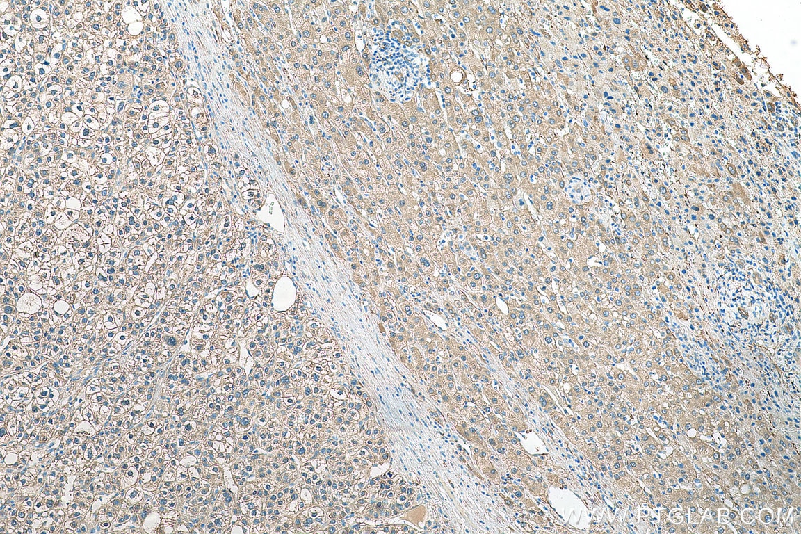 IHC staining of human liver cancer using 29373-1-AP