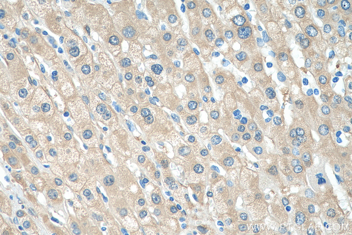 Immunohistochemistry (IHC) staining of human liver cancer tissue using ALDH1A3 Polyclonal antibody (29373-1-AP)
