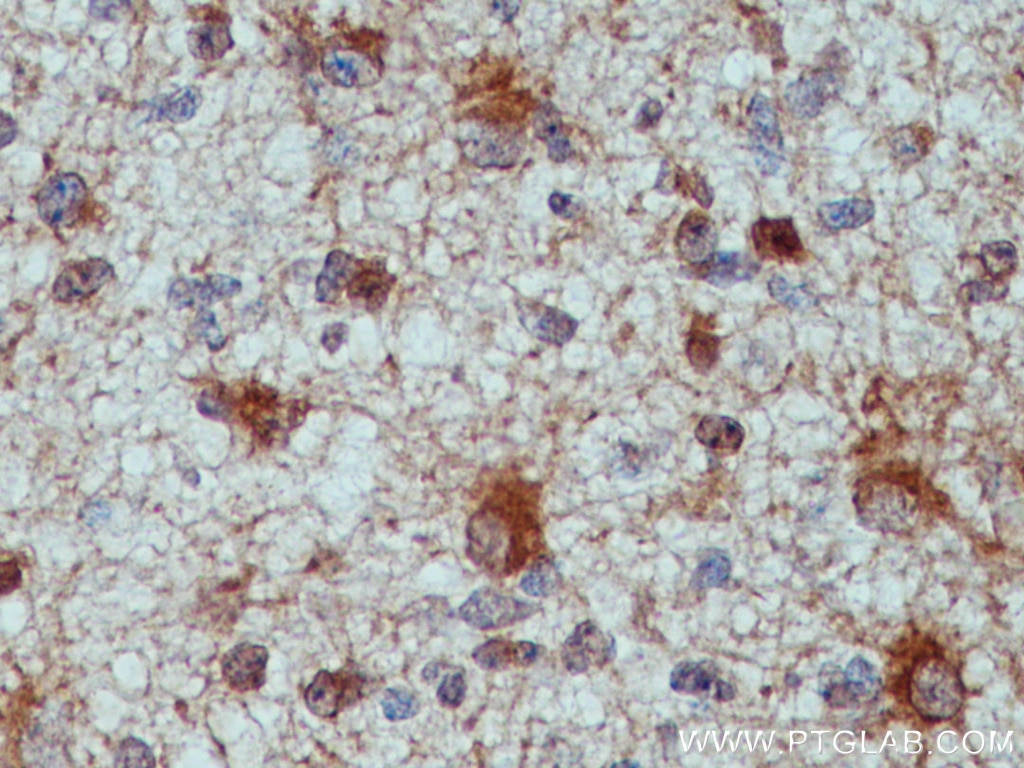 IHC staining of human gliomas using 17390-1-AP