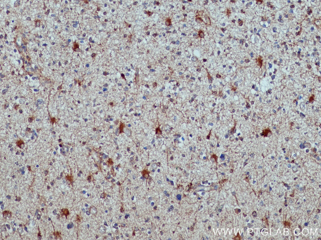 IHC staining of human gliomas using 17390-1-AP