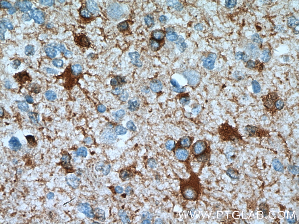 Immunohistochemistry (IHC) staining of human gliomas tissue using ALDH1L1 Polyclonal antibody (17390-1-AP)