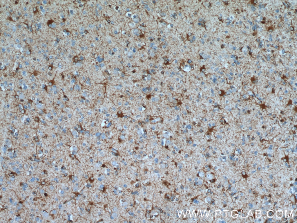 Immunohistochemistry (IHC) staining of human gliomas tissue using ALDH1L1 Polyclonal antibody (17390-1-AP)