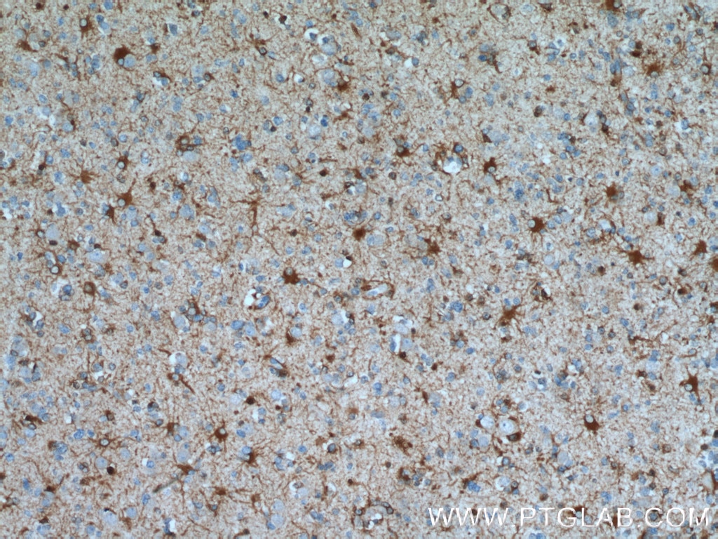 IHC staining of human gliomas using 17390-1-AP