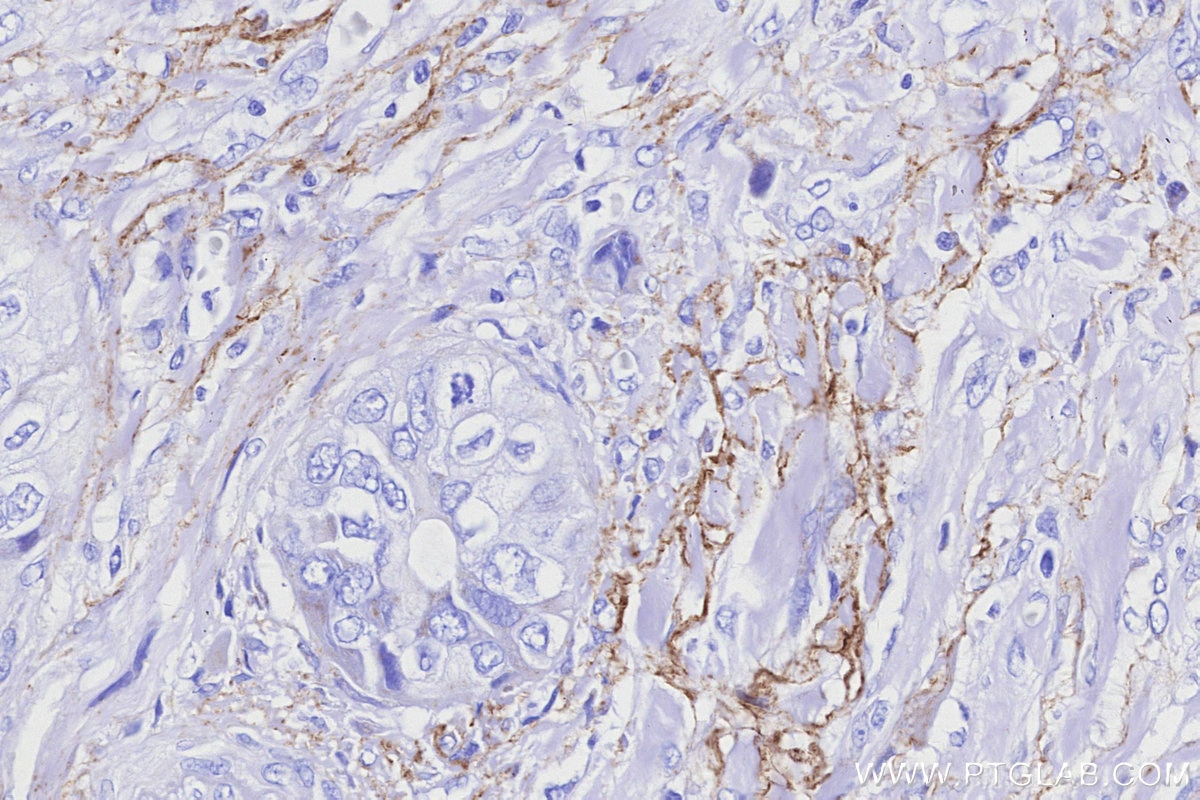 Immunohistochemistry (IHC) staining of human pancreas cancer tissue using ALDH1L1 Recombinant monoclonal antibody (85980-2-RR)