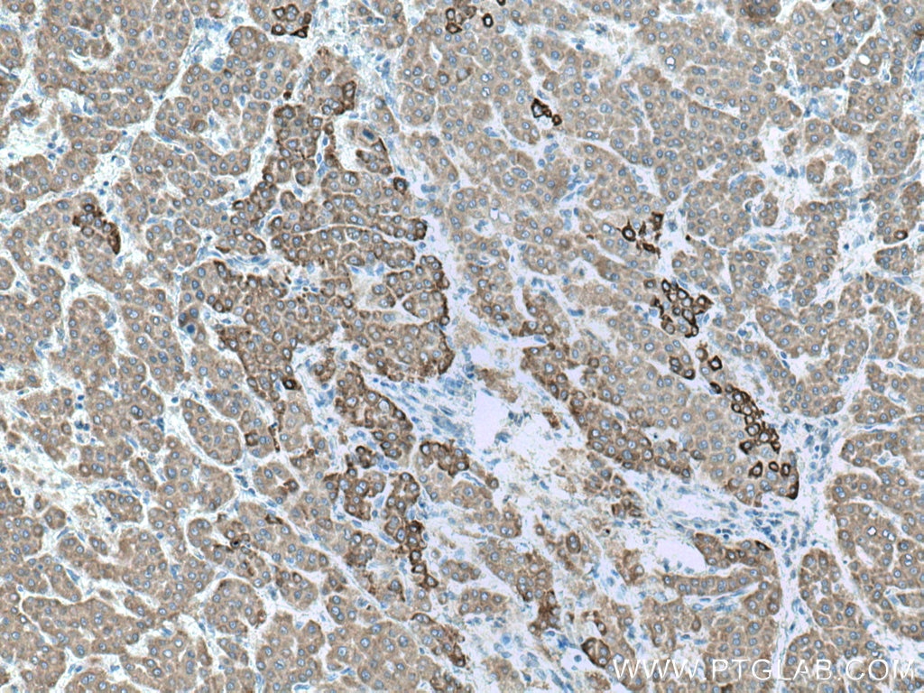 Immunohistochemistry (IHC) staining of human liver cancer tissue using ALDH3A2 Polyclonal antibody (15090-1-AP)