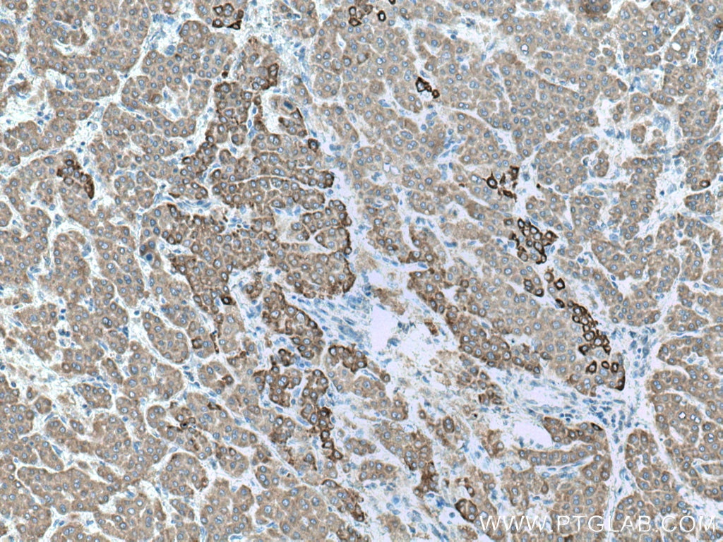 IHC staining of human liver cancer using 15090-1-AP