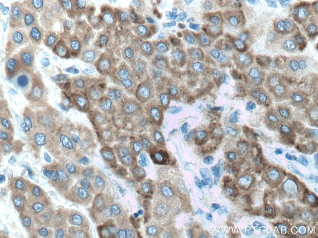 Immunohistochemistry (IHC) staining of human liver cancer tissue using ALDH3A2 Polyclonal antibody (15090-1-AP)