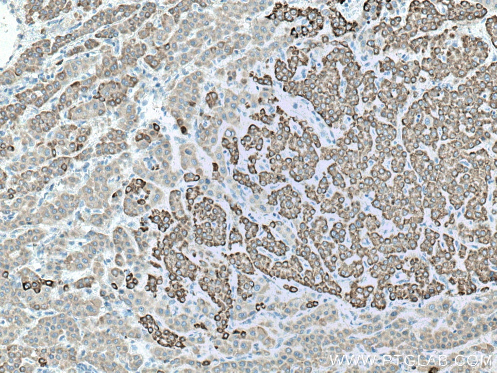 Immunohistochemistry (IHC) staining of human liver cancer tissue using ALDH3A2 Polyclonal antibody (15090-1-AP)