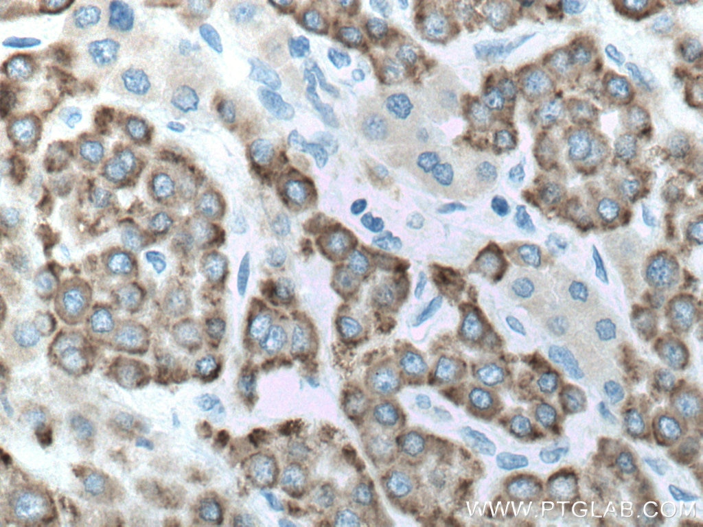 Immunohistochemistry (IHC) staining of human liver cancer tissue using ALDH3A2 Polyclonal antibody (15090-1-AP)