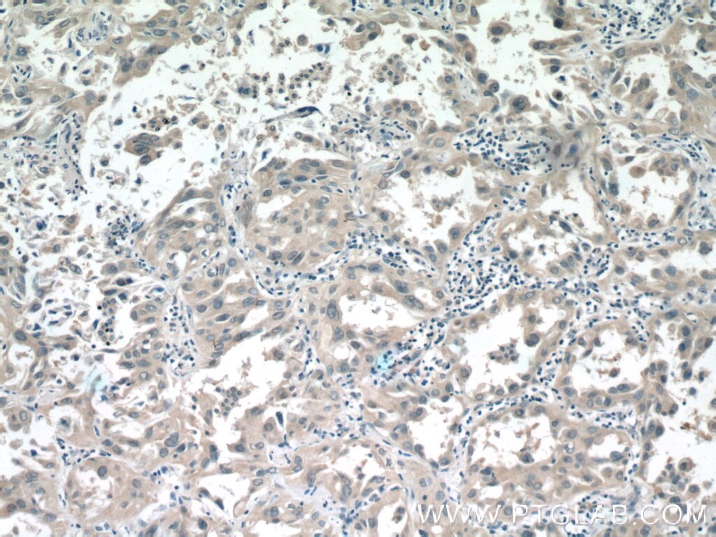 Immunohistochemistry (IHC) staining of human lung cancer tissue using ALDH3B1 Polyclonal antibody (19446-1-AP)