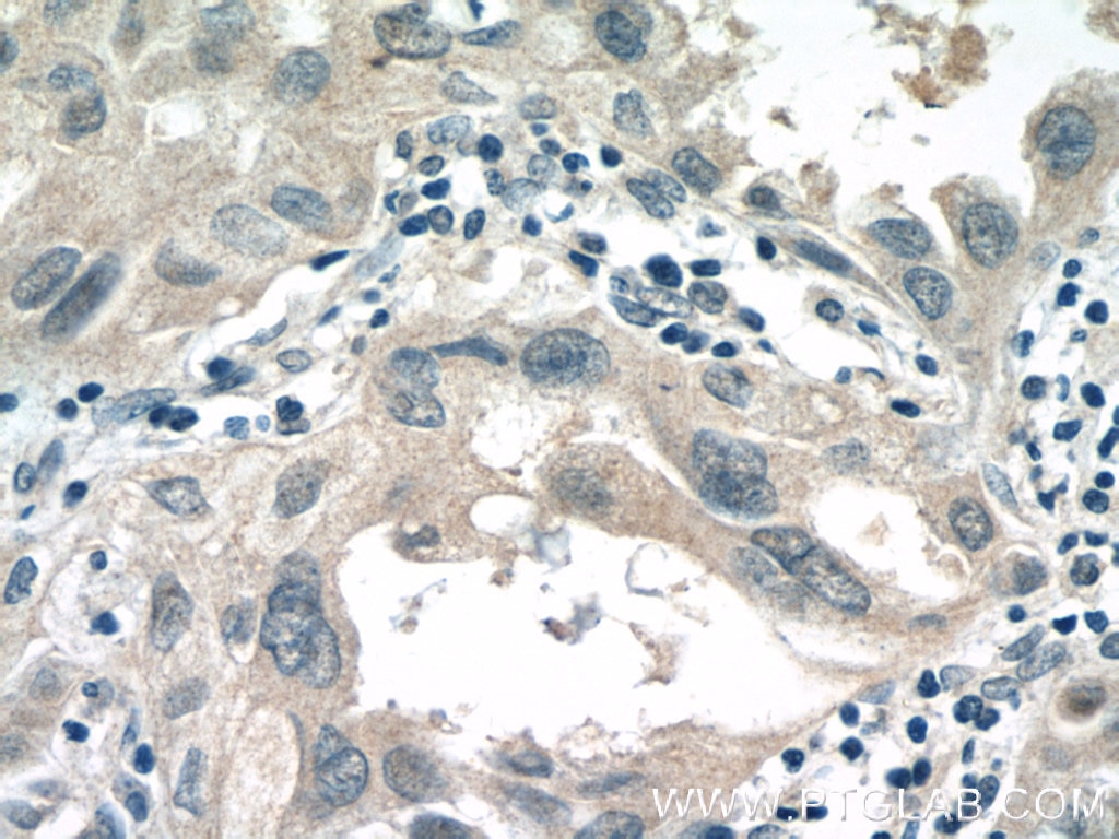 Immunohistochemistry (IHC) staining of human lung cancer tissue using ALDH3B1 Polyclonal antibody (19446-1-AP)