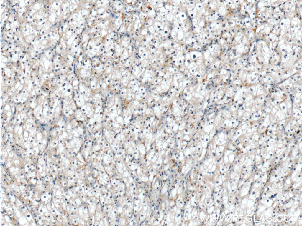 Immunohistochemistry (IHC) staining of human renal cell carcinoma tissue using ALDH3B1 Polyclonal antibody (19446-1-AP)