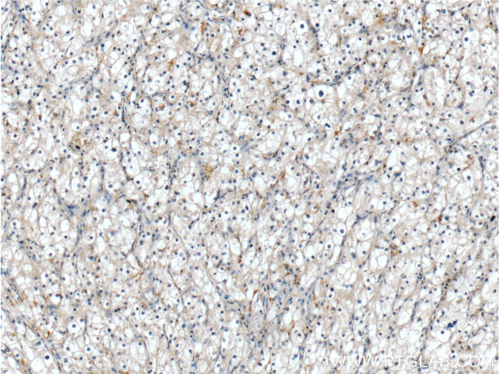 IHC staining of human renal cell carcinoma using 19446-1-AP