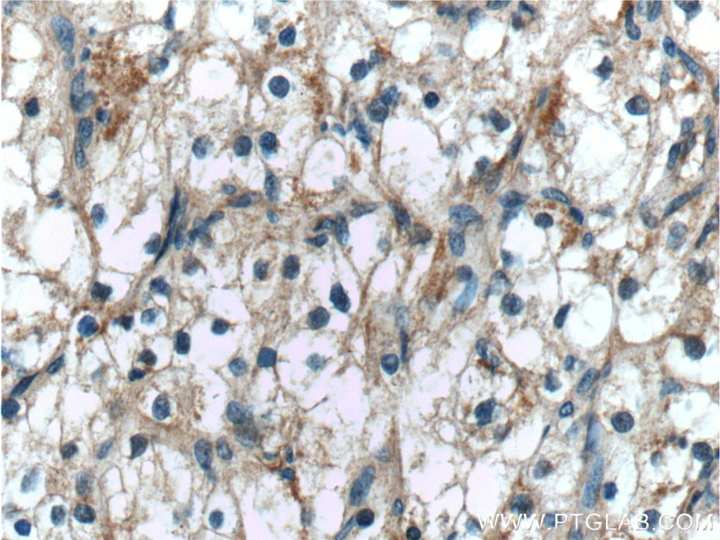 Immunohistochemistry (IHC) staining of human renal cell carcinoma tissue using ALDH3B1 Polyclonal antibody (19446-1-AP)