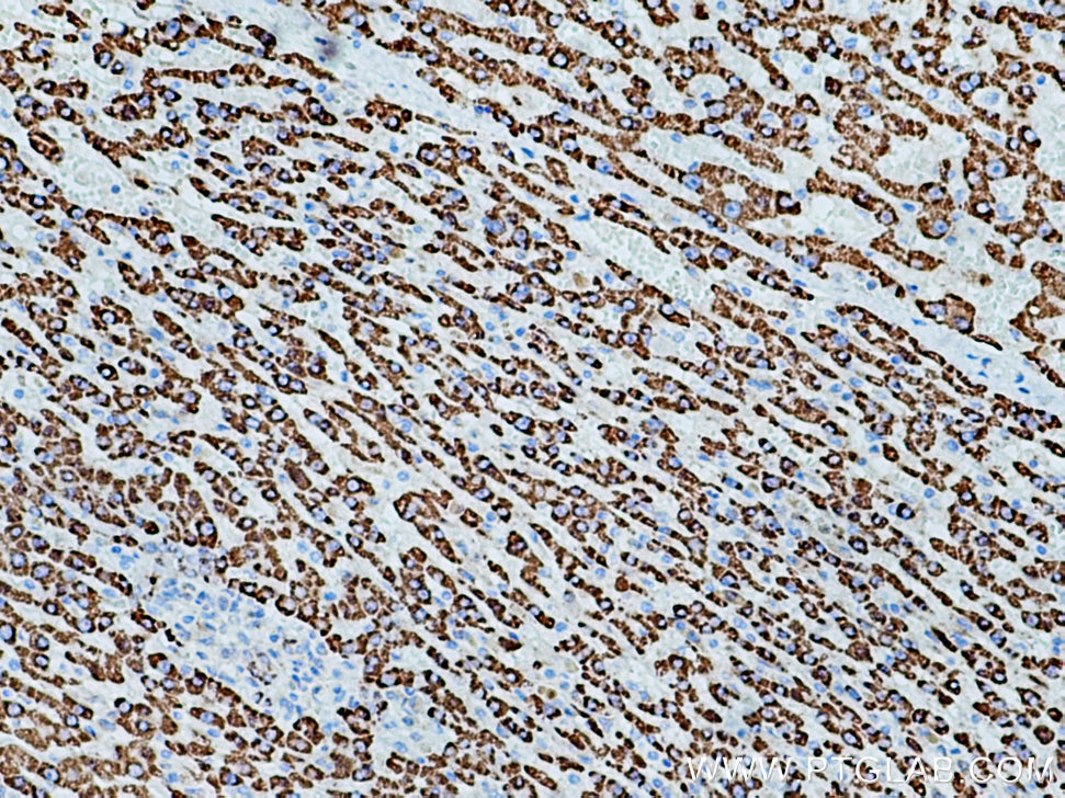 Immunohistochemistry (IHC) staining of human liver cancer tissue using ALDH4A1 Polyclonal antibody (11604-1-AP)