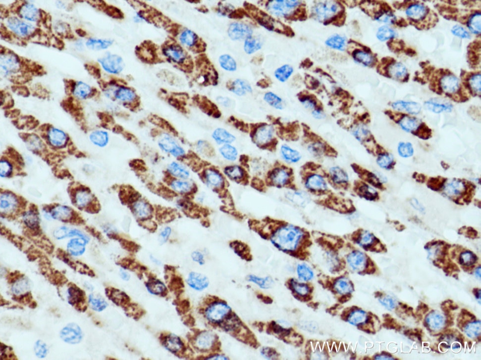 Immunohistochemistry (IHC) staining of human liver cancer tissue using ALDH4A1 Polyclonal antibody (11604-1-AP)