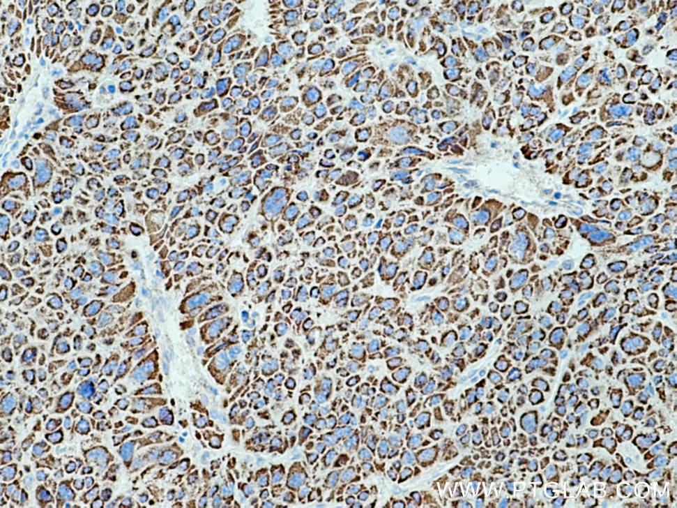 Immunohistochemistry (IHC) staining of human liver cancer tissue using ALDH4A1 Polyclonal antibody (11604-1-AP)