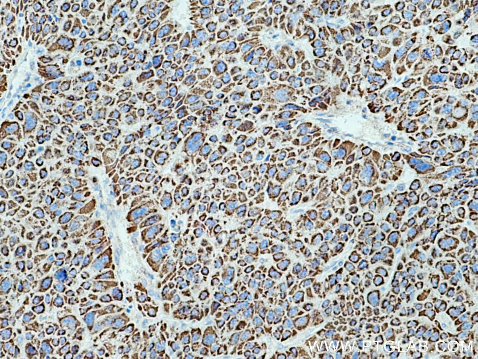 IHC staining of human liver cancer using 11604-1-AP