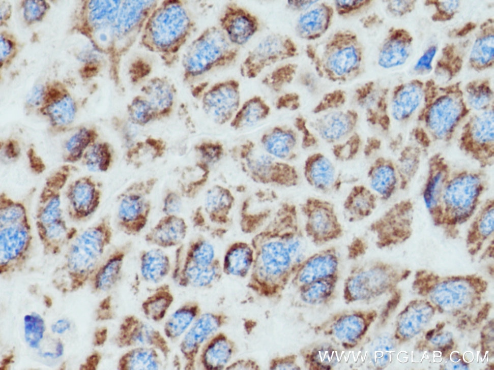 Immunohistochemistry (IHC) staining of human liver cancer tissue using ALDH4A1 Polyclonal antibody (11604-1-AP)
