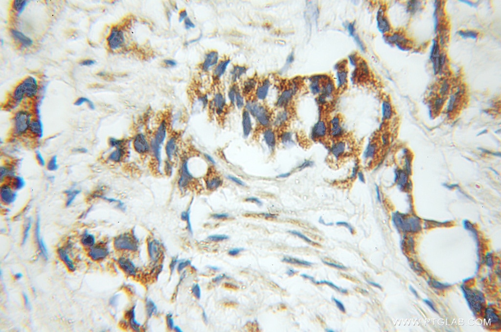 Immunohistochemistry (IHC) staining of human prostate cancer tissue using ALDH4A1 Polyclonal antibody (11604-1-AP)