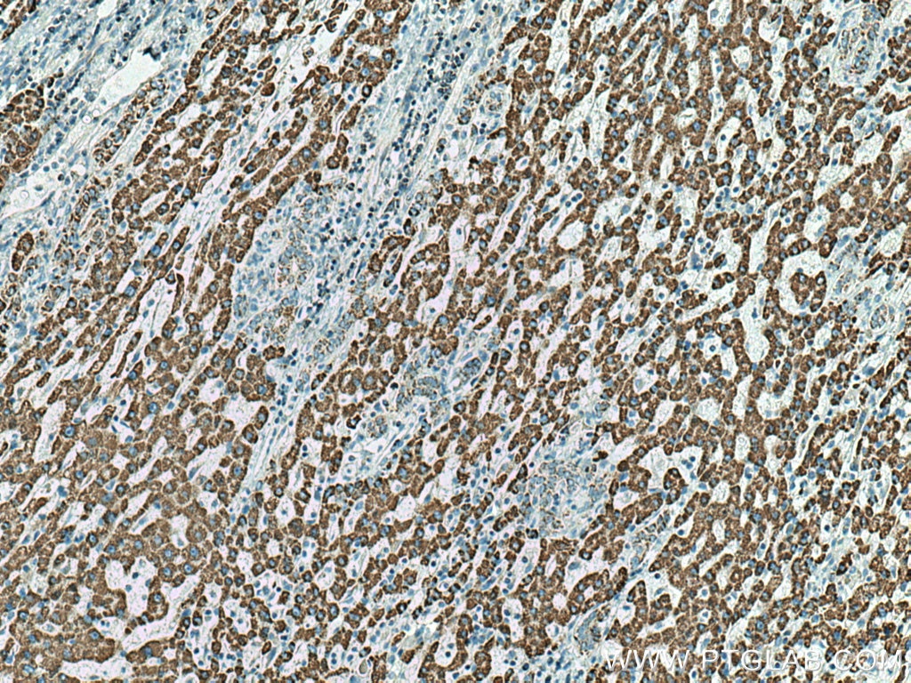 Immunohistochemistry (IHC) staining of human liver cancer tissue using ALDH5A1 Polyclonal antibody (17319-1-AP)